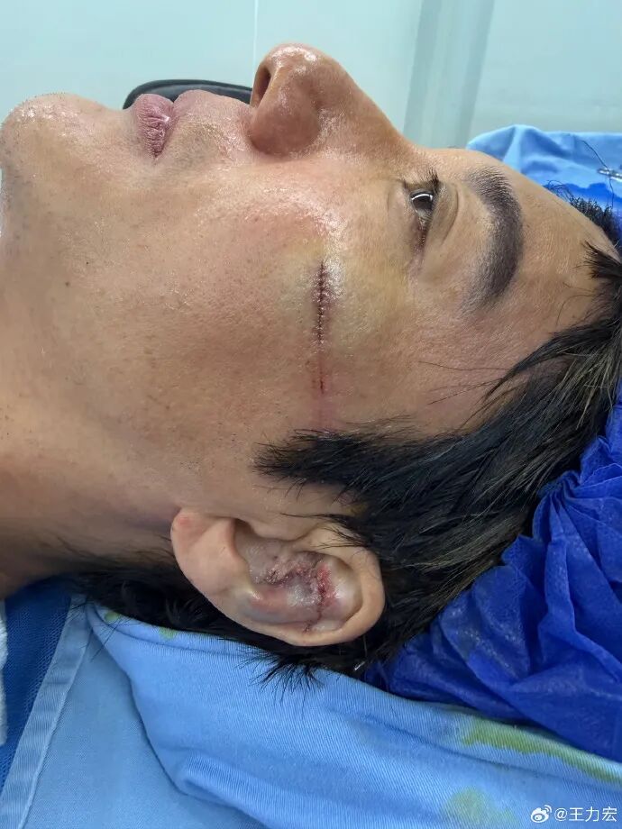王力宏发视频透露伤情：受伤7天后伤口恢复状况良好，次日便可以拆线，从长沙站演出开始，将取消取景框等舞台装置